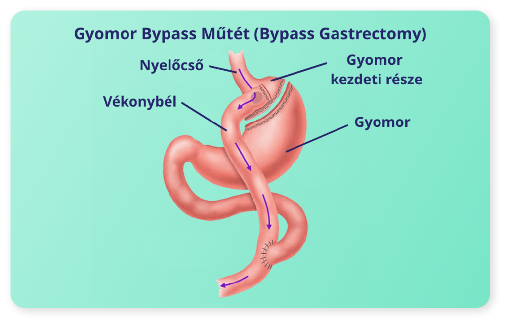 Bariátriai Műtétek Bypass Gastrectomy