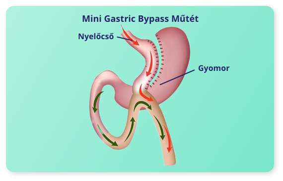 Mini Gastric Bypass Bariátriai Műtét