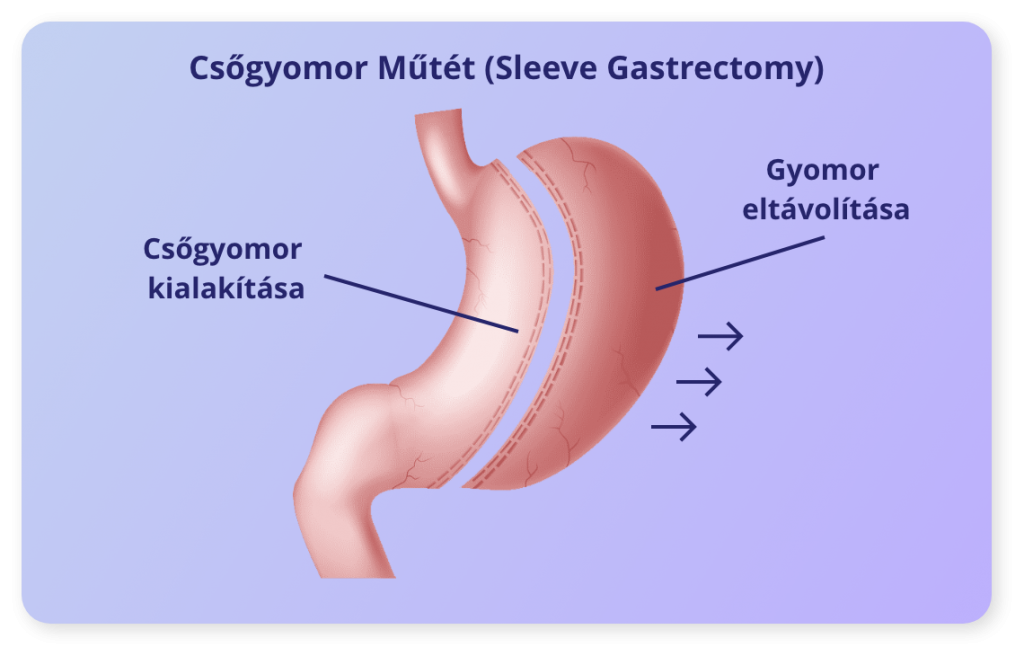 Bariátriai Műtétek Sleeve Gastrectomy
